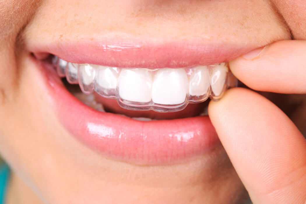 Close up of a person putting in clear aligners in San Antonio, TX