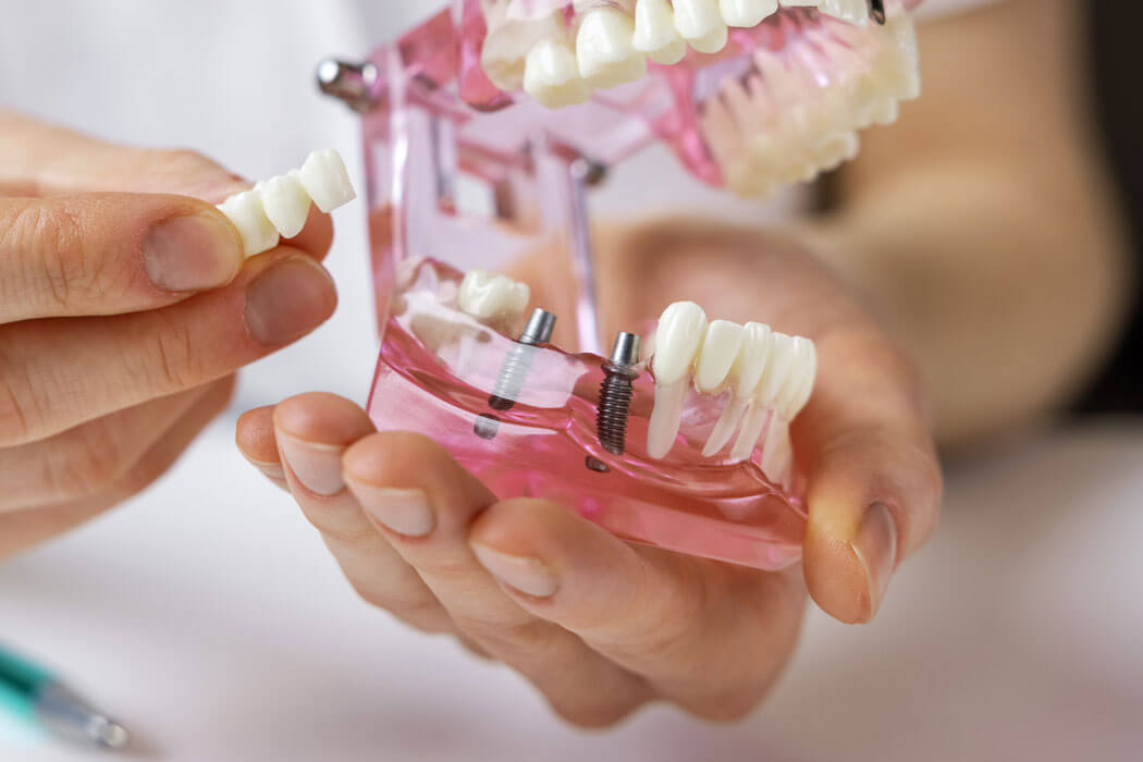 Dentist showing dental bridge implant technology on human tooth jaw model