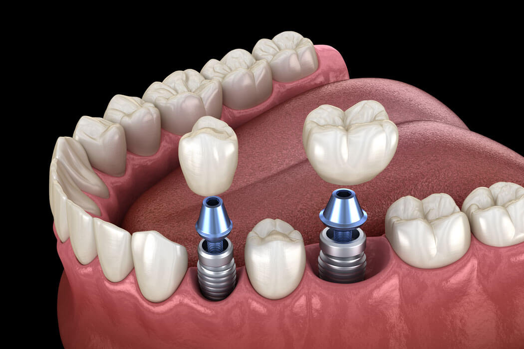 dental implant and crowns 3D model render