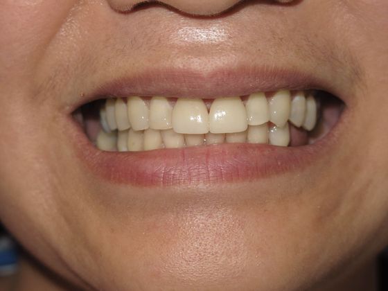 patient's teeth after dental crown treatment in San Antonio, TX