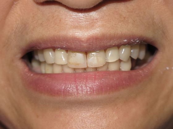 patient's teeth before dental crown treatment in San Antonio, TX