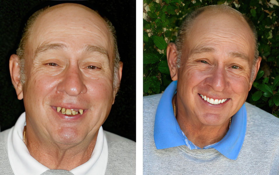 patient's before and after denture implant procedure in San Antonio, TX